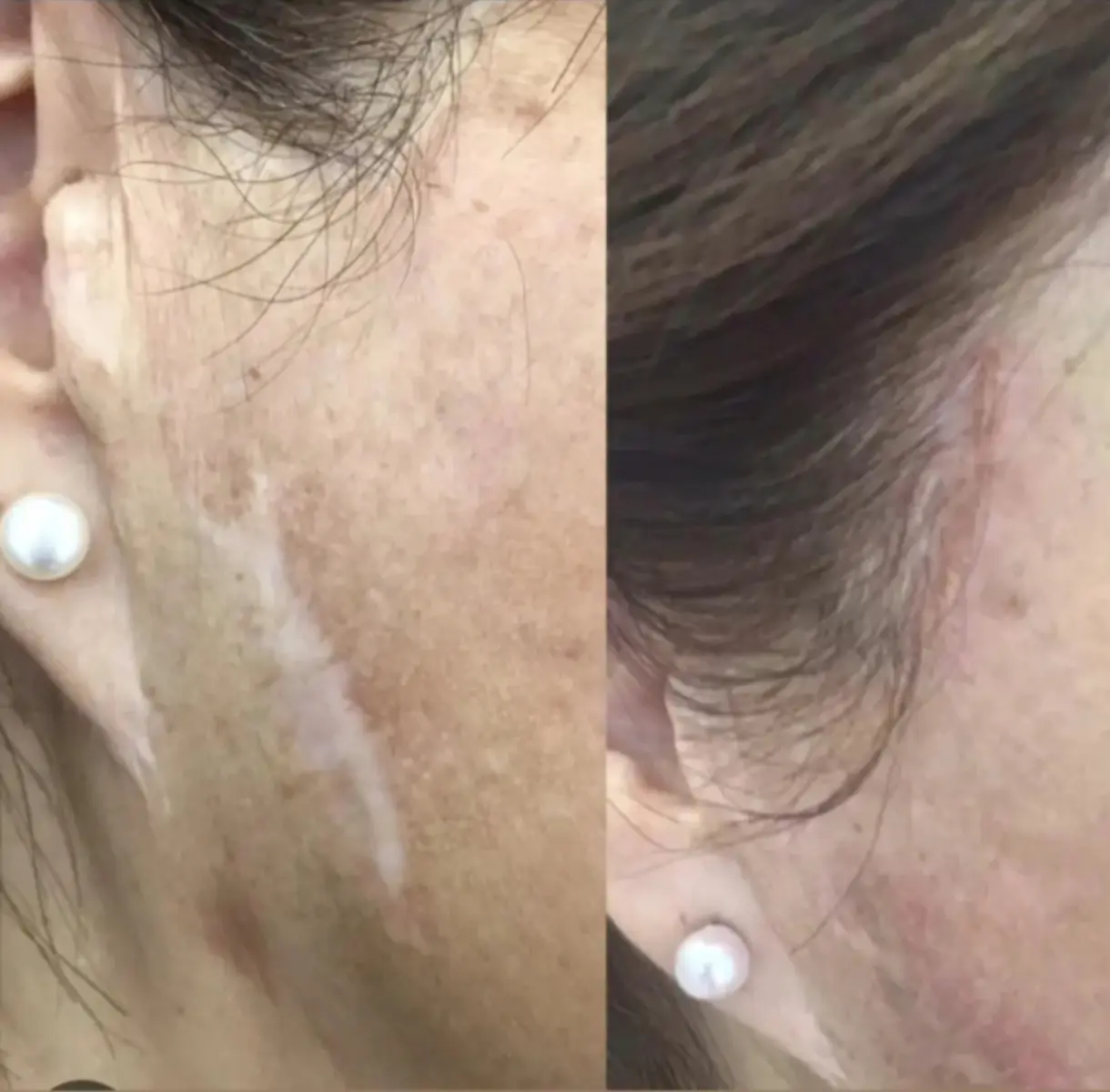 Camuflaje estético de cicatriz con micropigmentación
