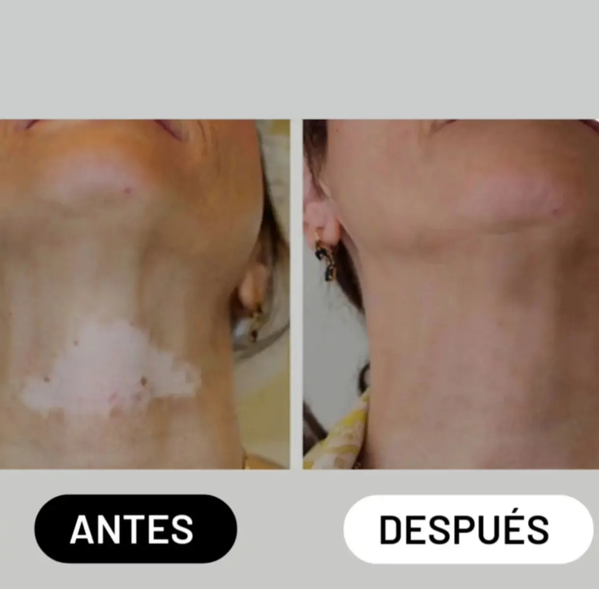 Igualación de tono de piel de despigmentación por vitigilo. Antes y después