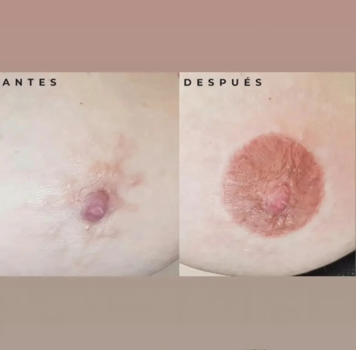 Antes y depués de reconstrucción de areola 3d post-masectomía. Micropigmentación